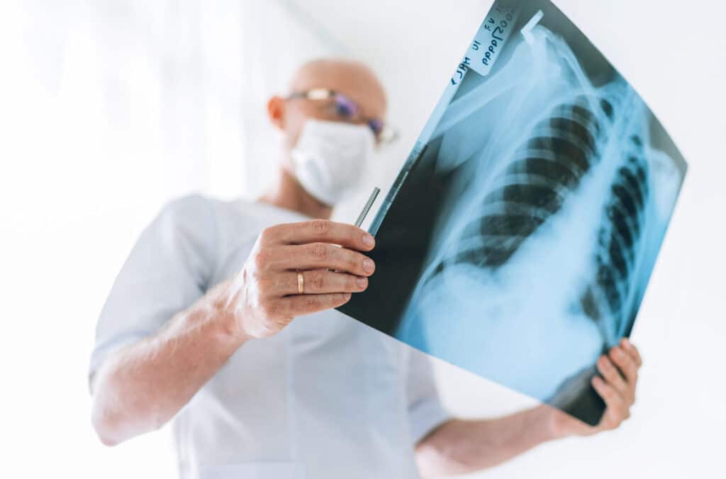 Legionnaires’ disease x ray